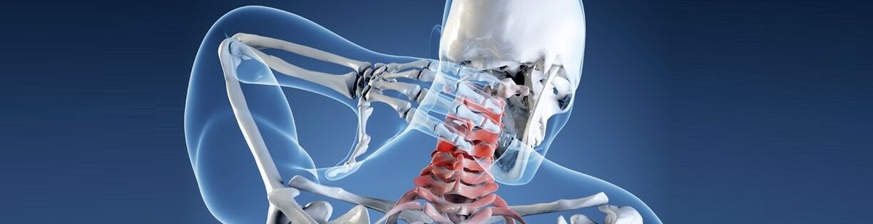 Žmogaus kaklo stuburo osteochondrozė