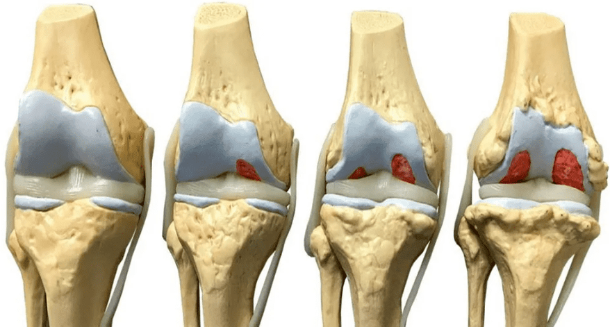 kelio sąnario pažeidimas įvairiais artrozės vystymosi etapais