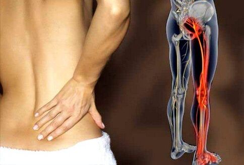 apatinės nugaros dalies skausmas dėl sėdimojo nervo uždegimo