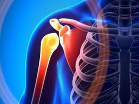 Peties sąnario uždegimas dėl artrozės – lėtinės raumenų ir kaulų sistemos ligos