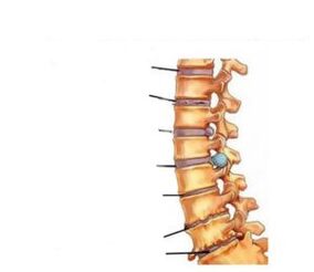 Osteochondrozės simptomai