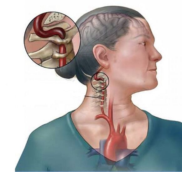 slankstelinių arterijų sindromas su gimdos kaklelio osteochondroze
