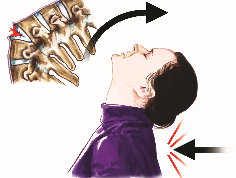 stuburo pažeidimas kaip kaklo skausmo priežastis