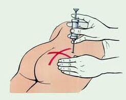 Injekcijos osteochondrozei gydyti