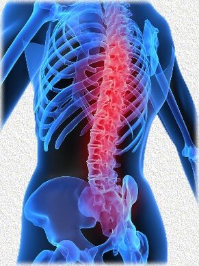 Osteochondrozė ir jos gydymo metodai